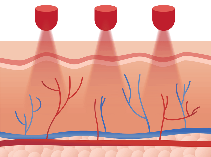 Illustration of blood vessels and skin layers with red colors.
